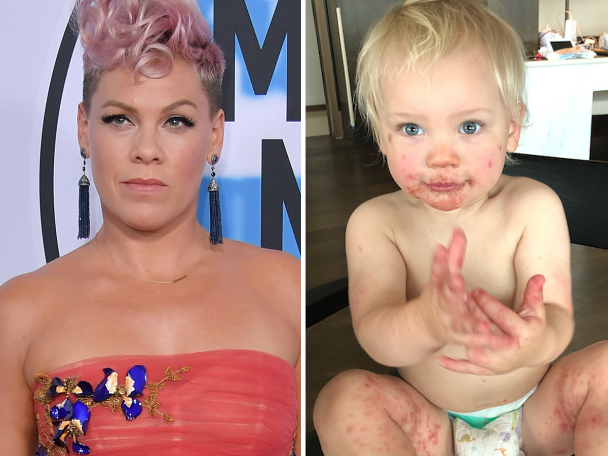 Pink's Son Has Hand, Foot, And Mouth Disease — Here's What It Is