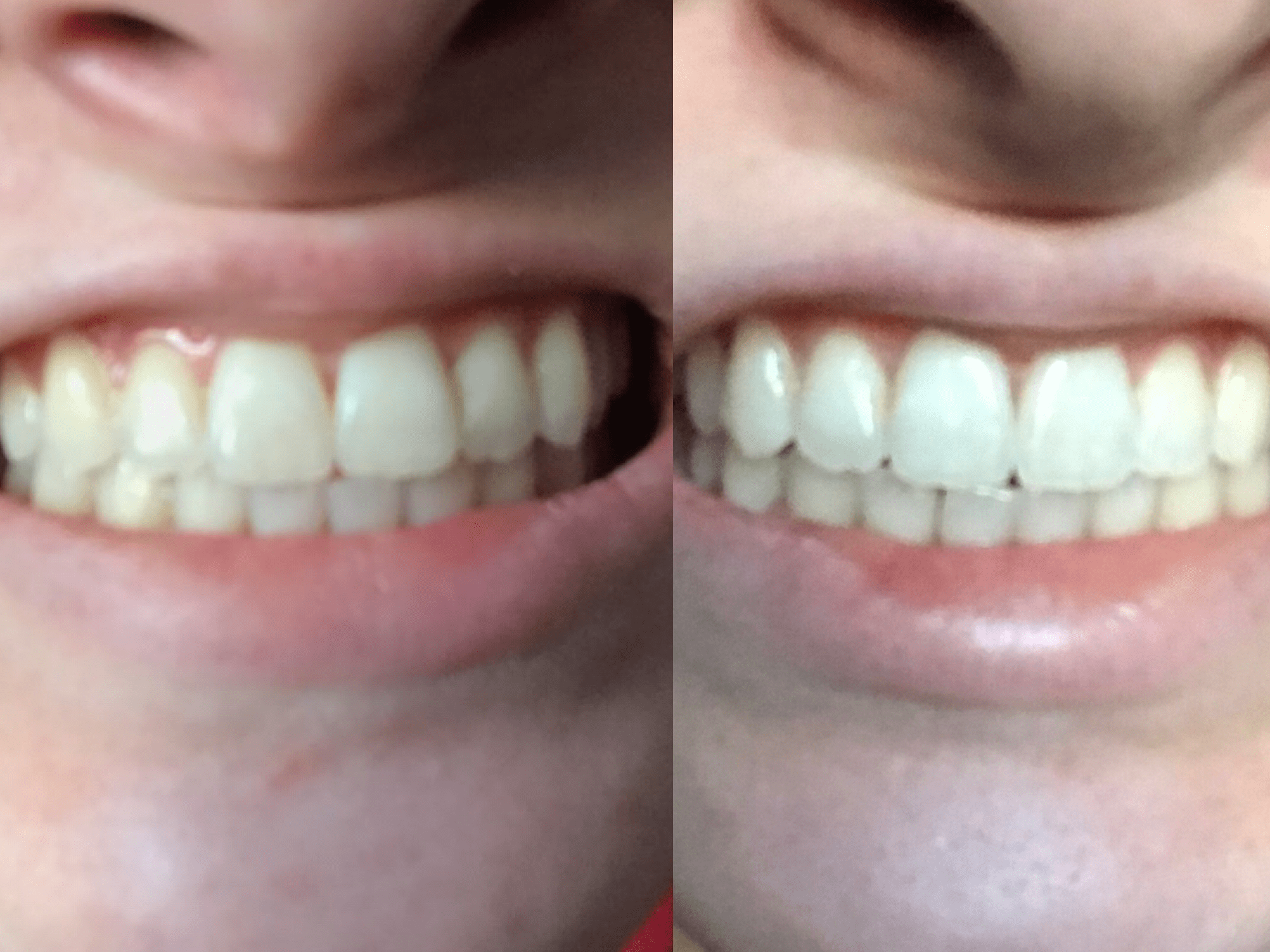 How Long Does It Take To Whiten Teeth With Toothpaste Teeth Poster