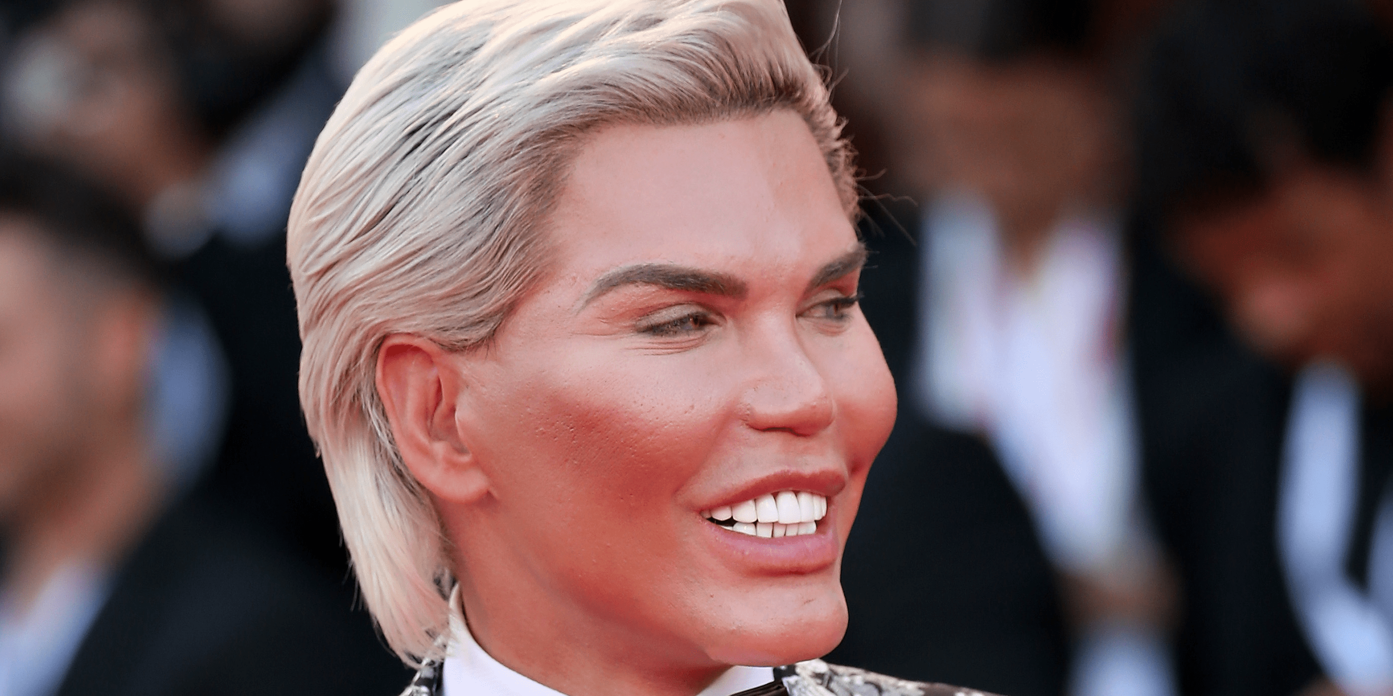 'Human Ken Doll' Had 72 Cosmetic Surgeries, a Dangerous Addiction