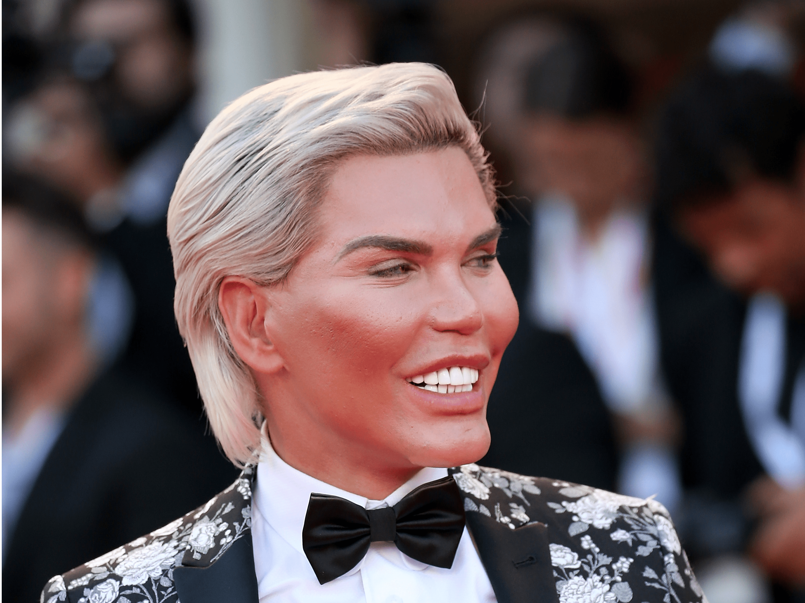 'Human Ken Doll' Had 72 Cosmetic Surgeries, a Dangerous Addiction