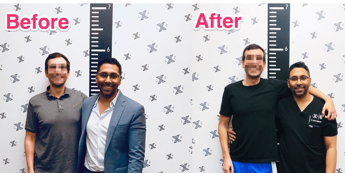 Men Are Paying 76,000 for a LimbExtending Surgery to Be Taller