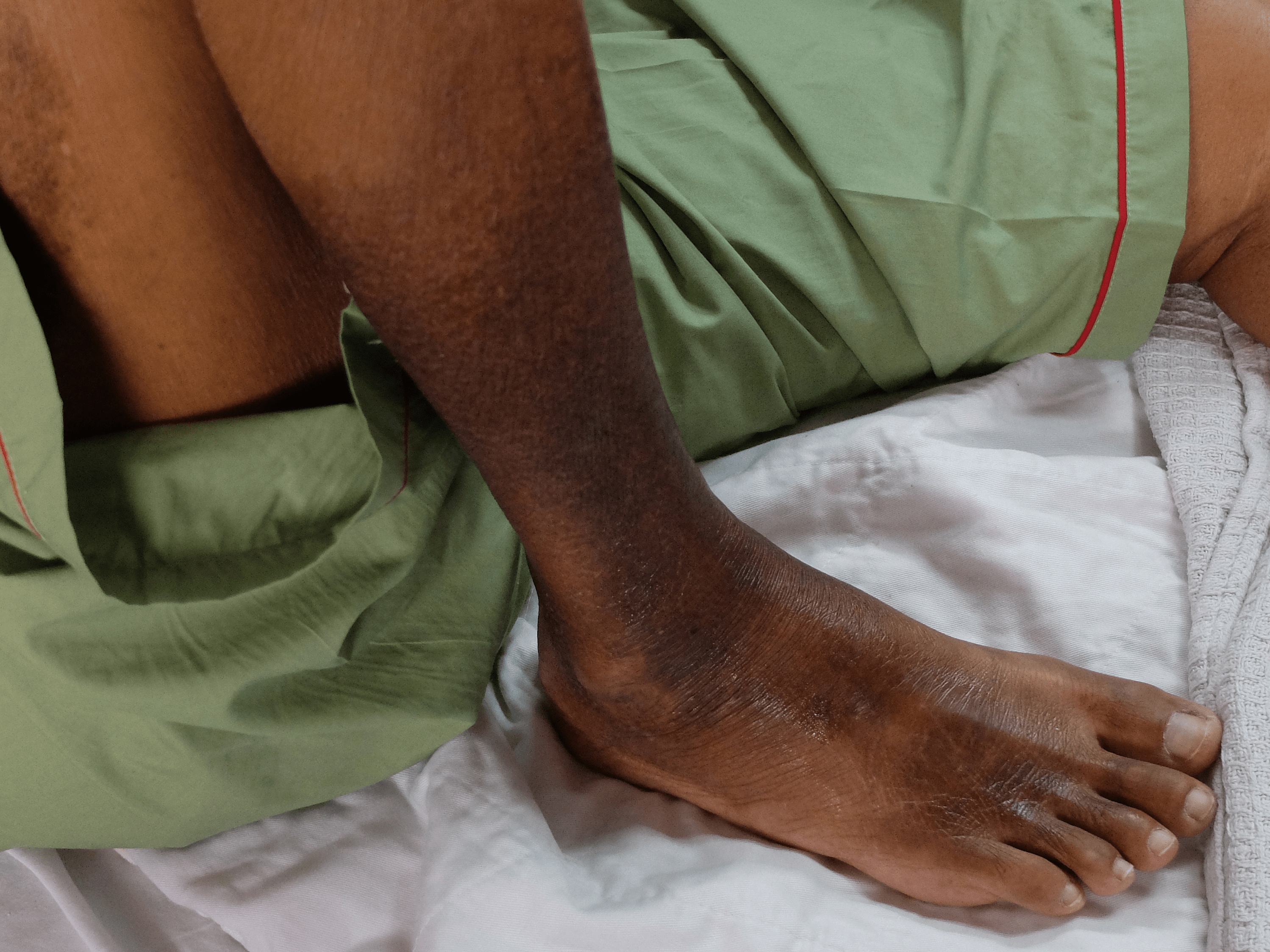 Symptoms Of Blood Clot In Leg After Pregnancy