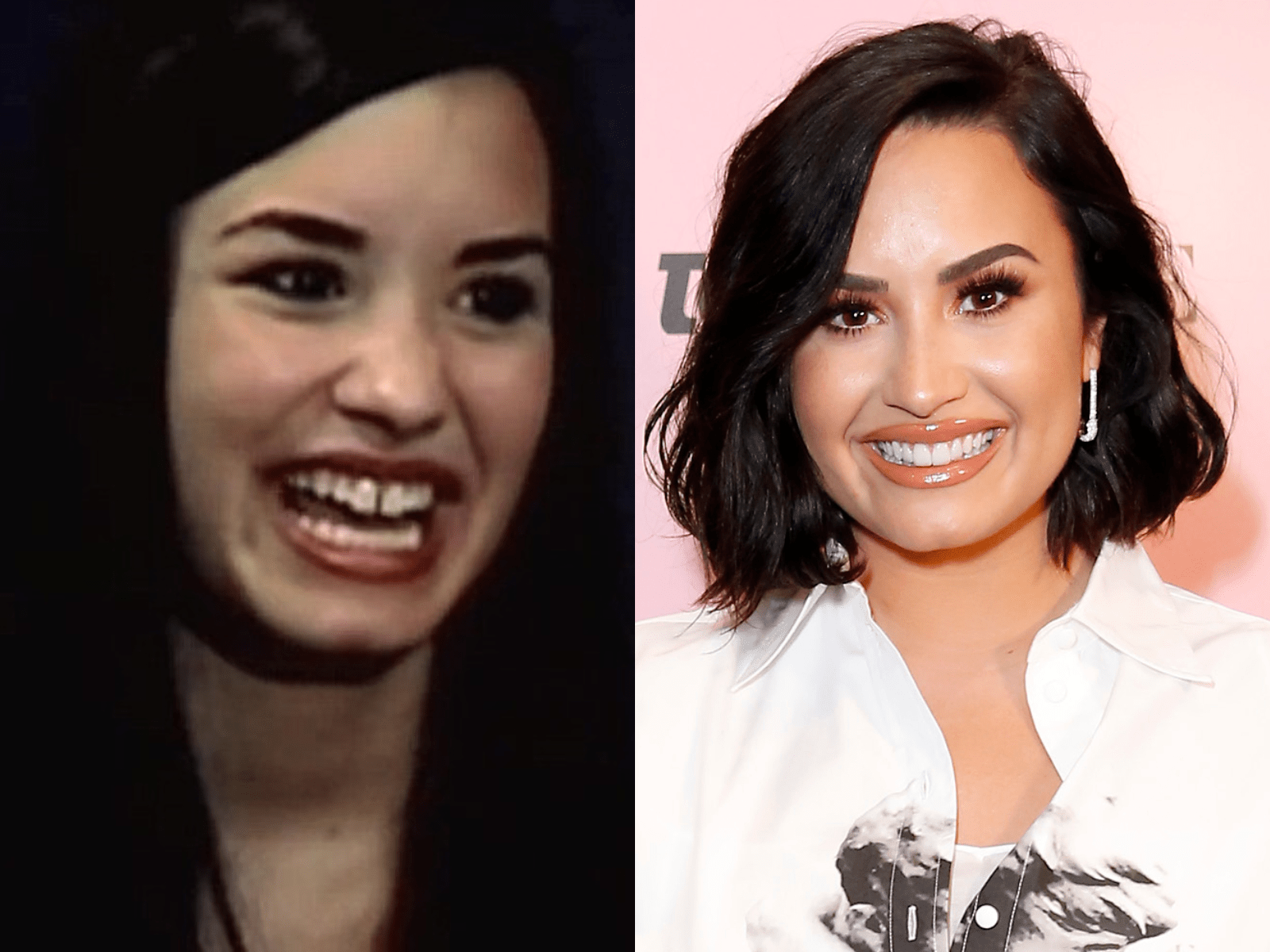 10 celebrities who have closed their tooth gaps Business
