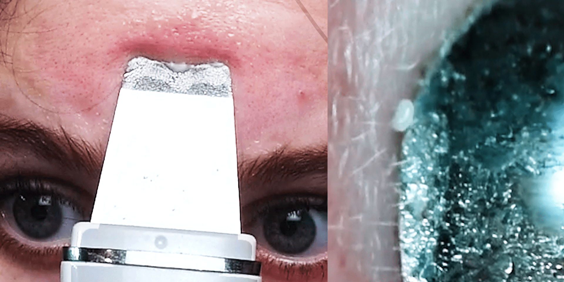 Pore Spatula Blackhead Extractions Under a Microscope Business Insider