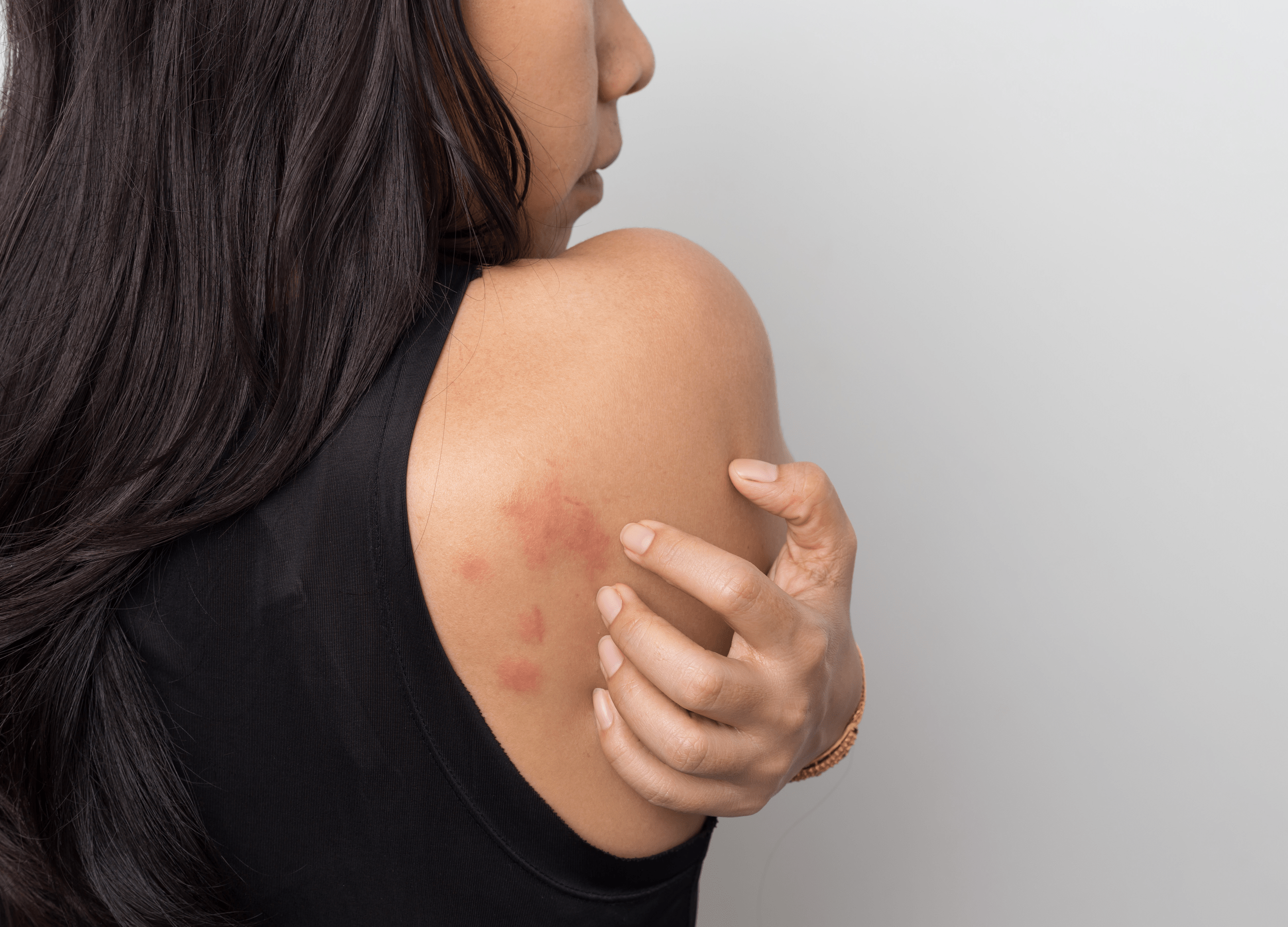 Can you be allergic to water? Aquagenic urticaria is a rare condition