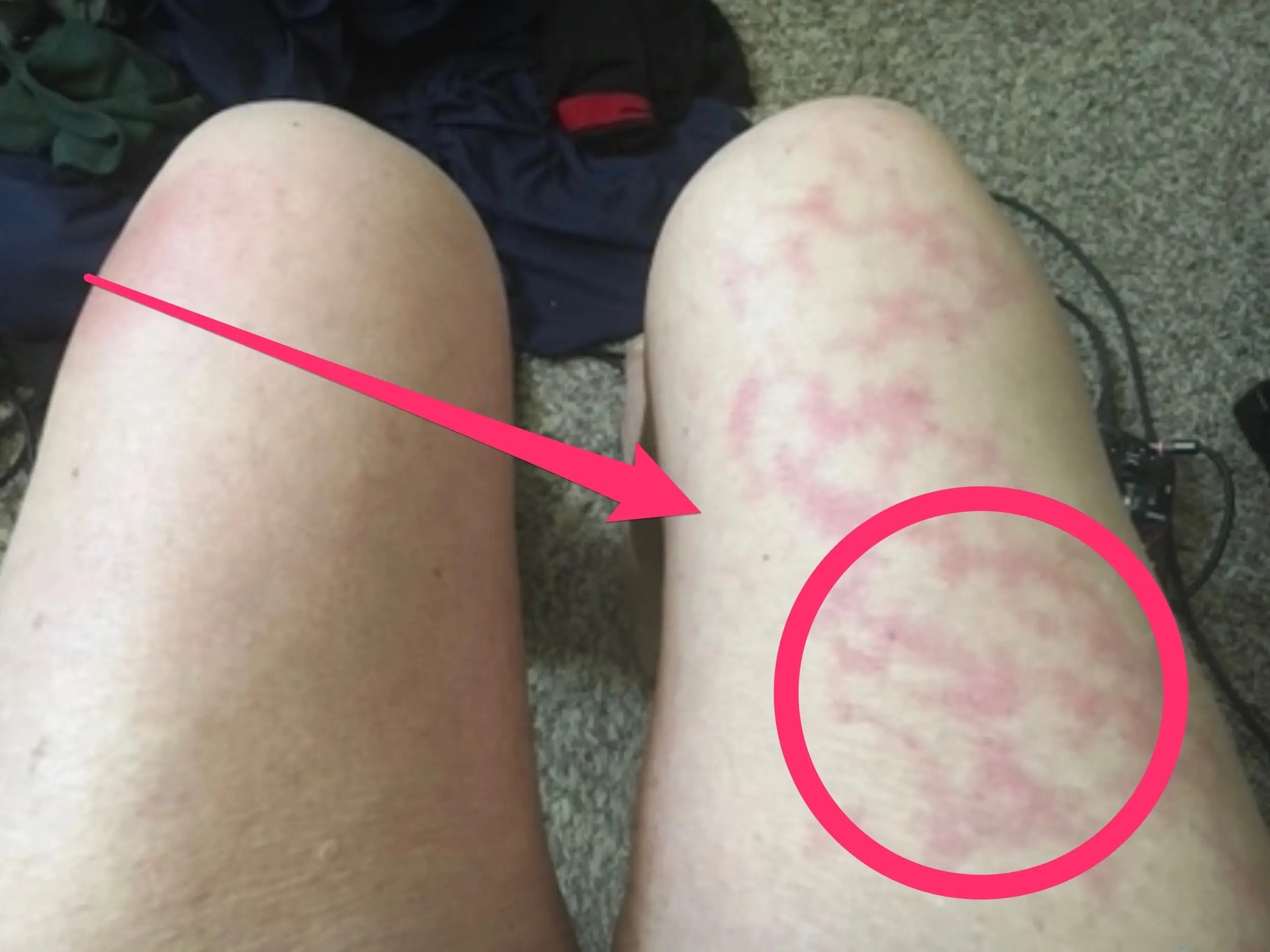 Unusual Skin Symptoms Of Coronavirus: Covid Toes, Blisters