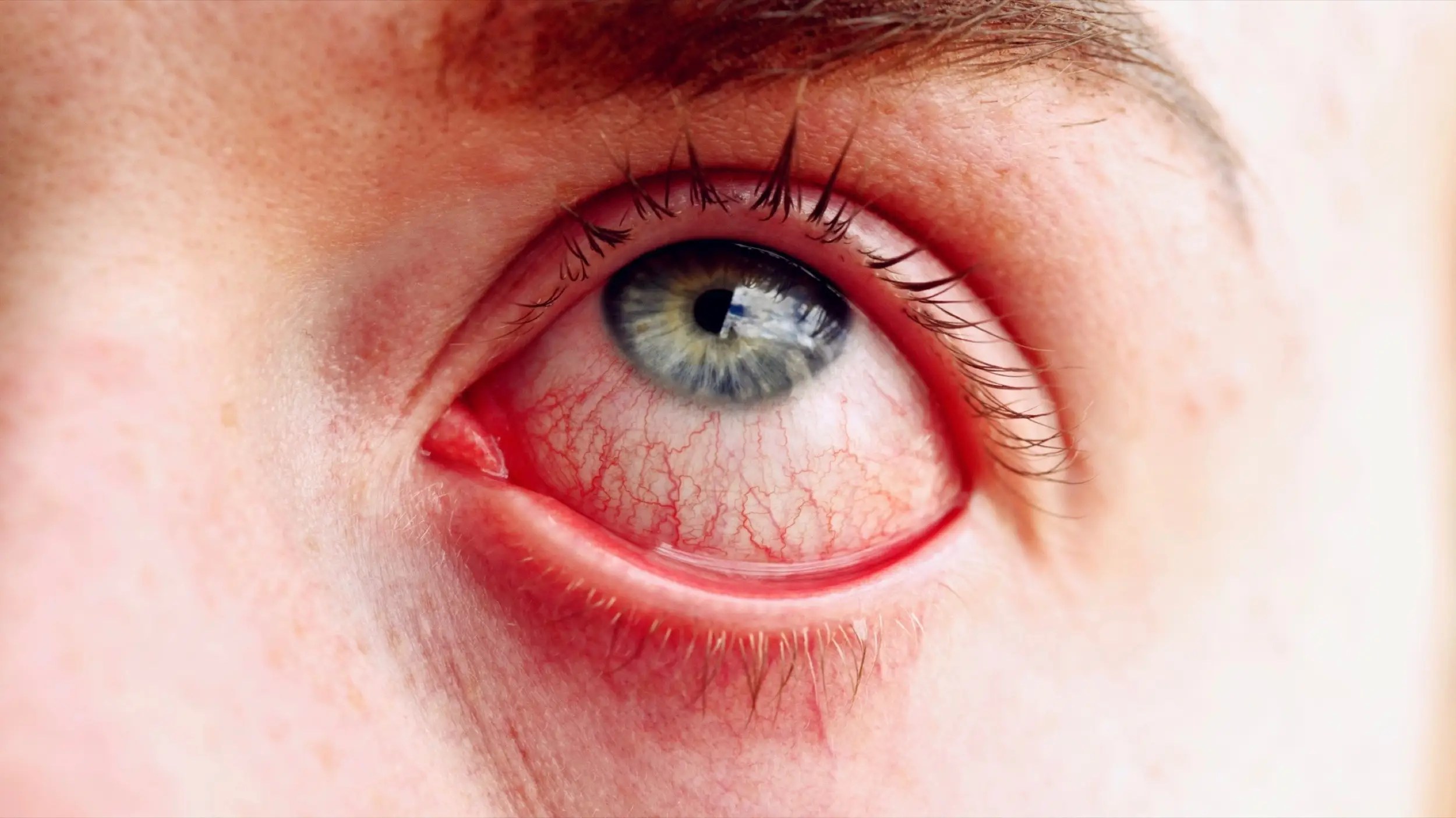 3 ways you can treat pink eye without a doctor's appointment