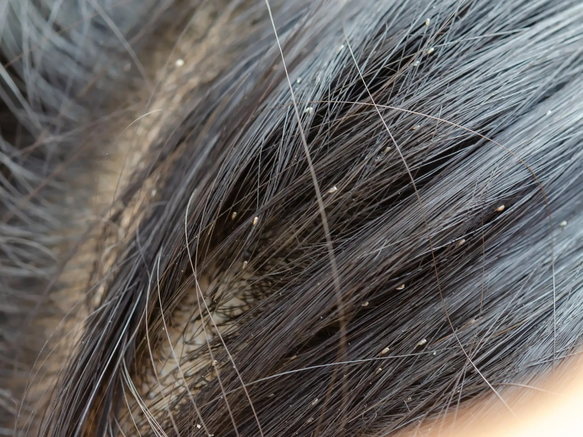 How do you get lice? Lice mainly spreads through headto