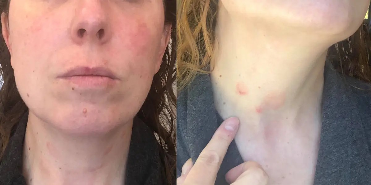 Coronavirus Long-Haulers Are Developing Rashes, A Sign Of Inflammation