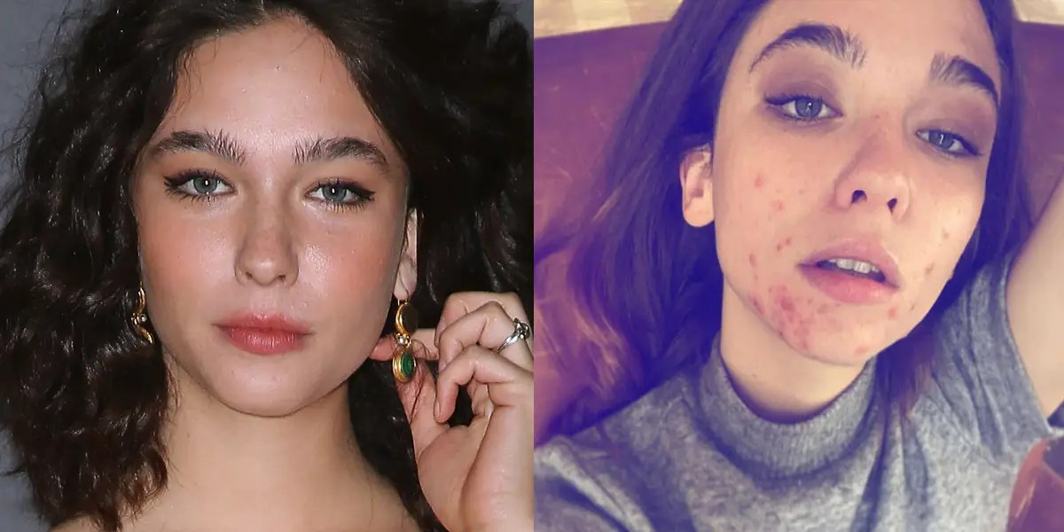 Matilda De Angelis of 'the Undoing' Talks About Having Acne Business