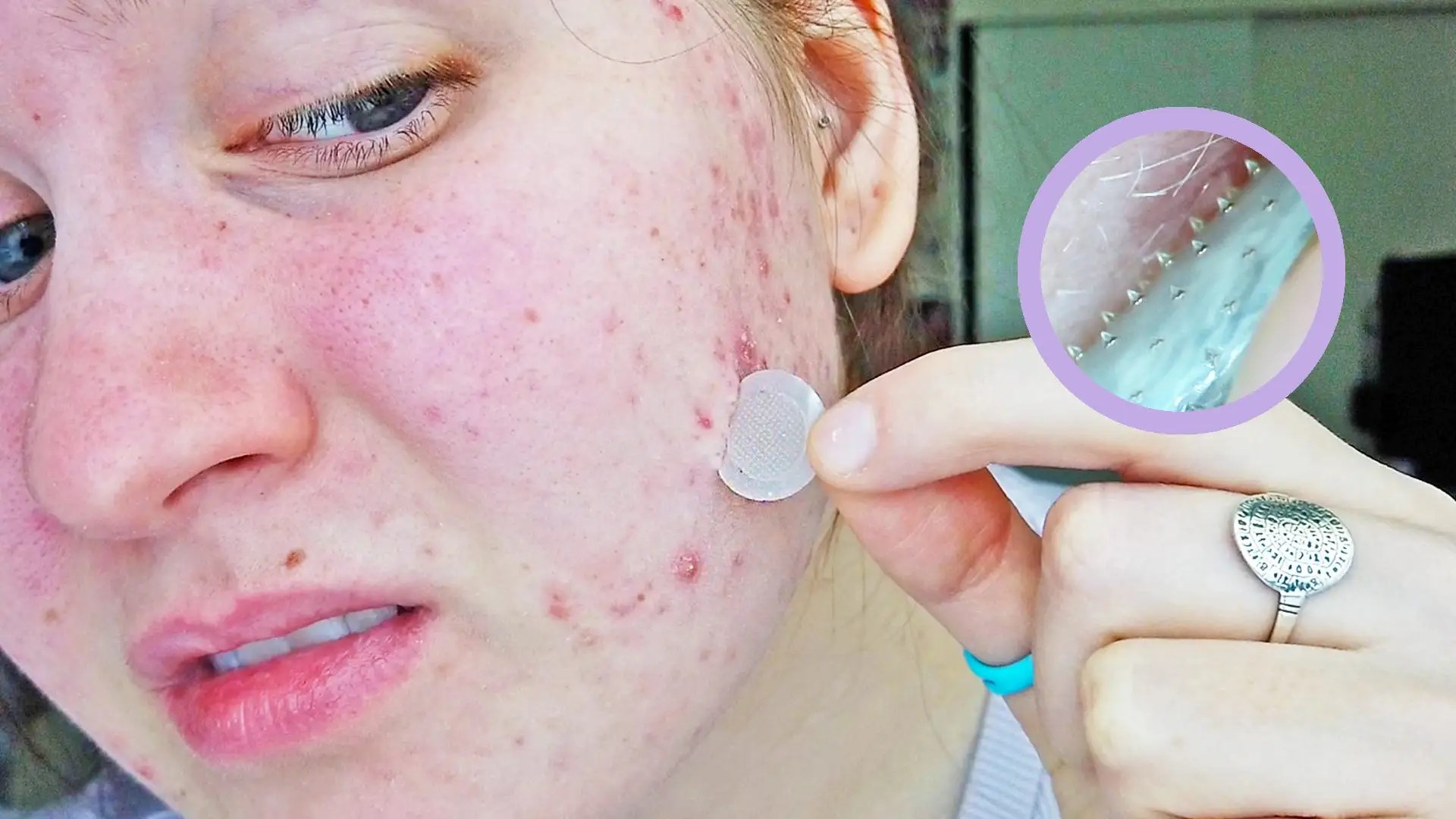 Tretinoin Before And After Acne