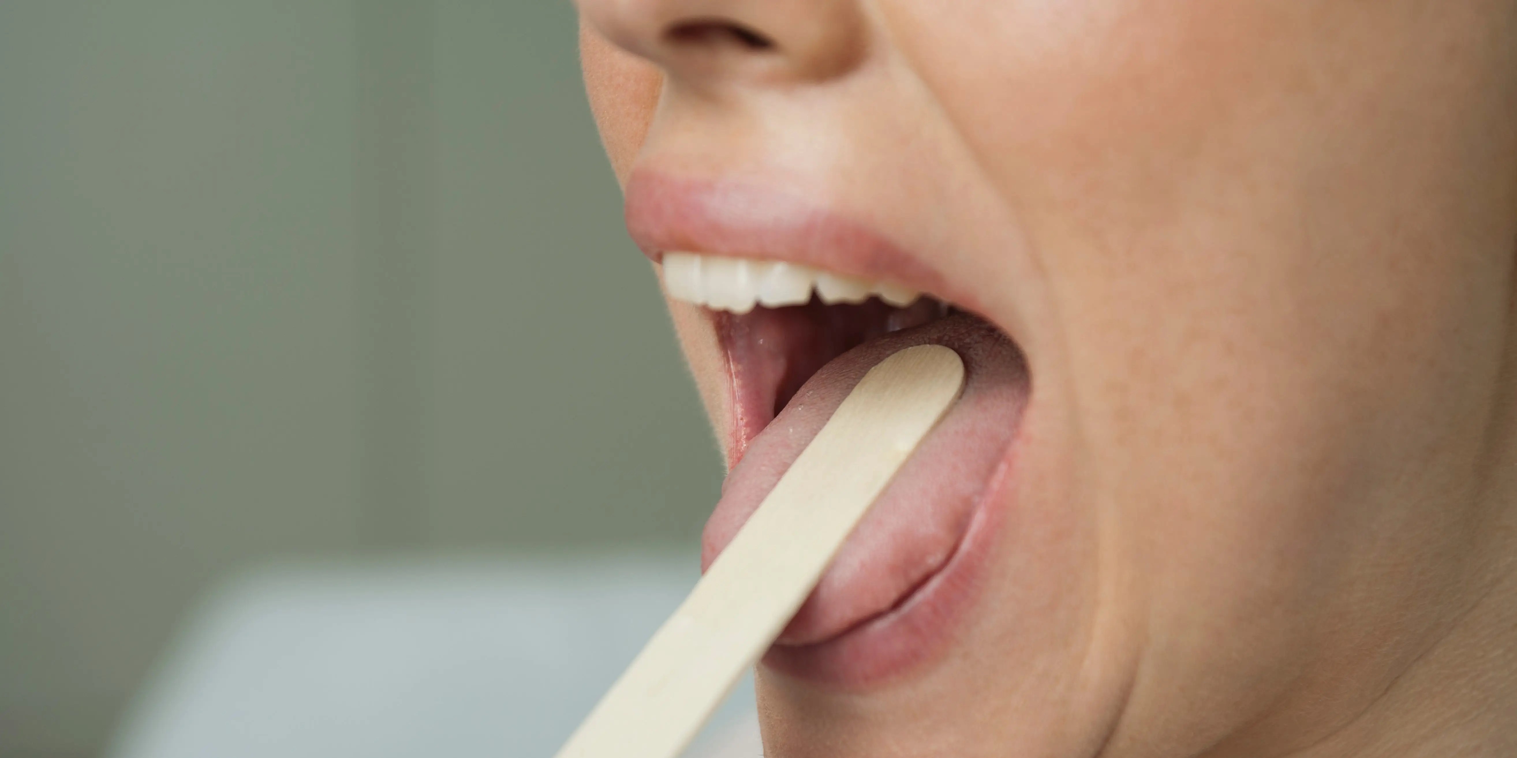 COVID tongue rash, mouth ulcers may be coronavirus symptoms