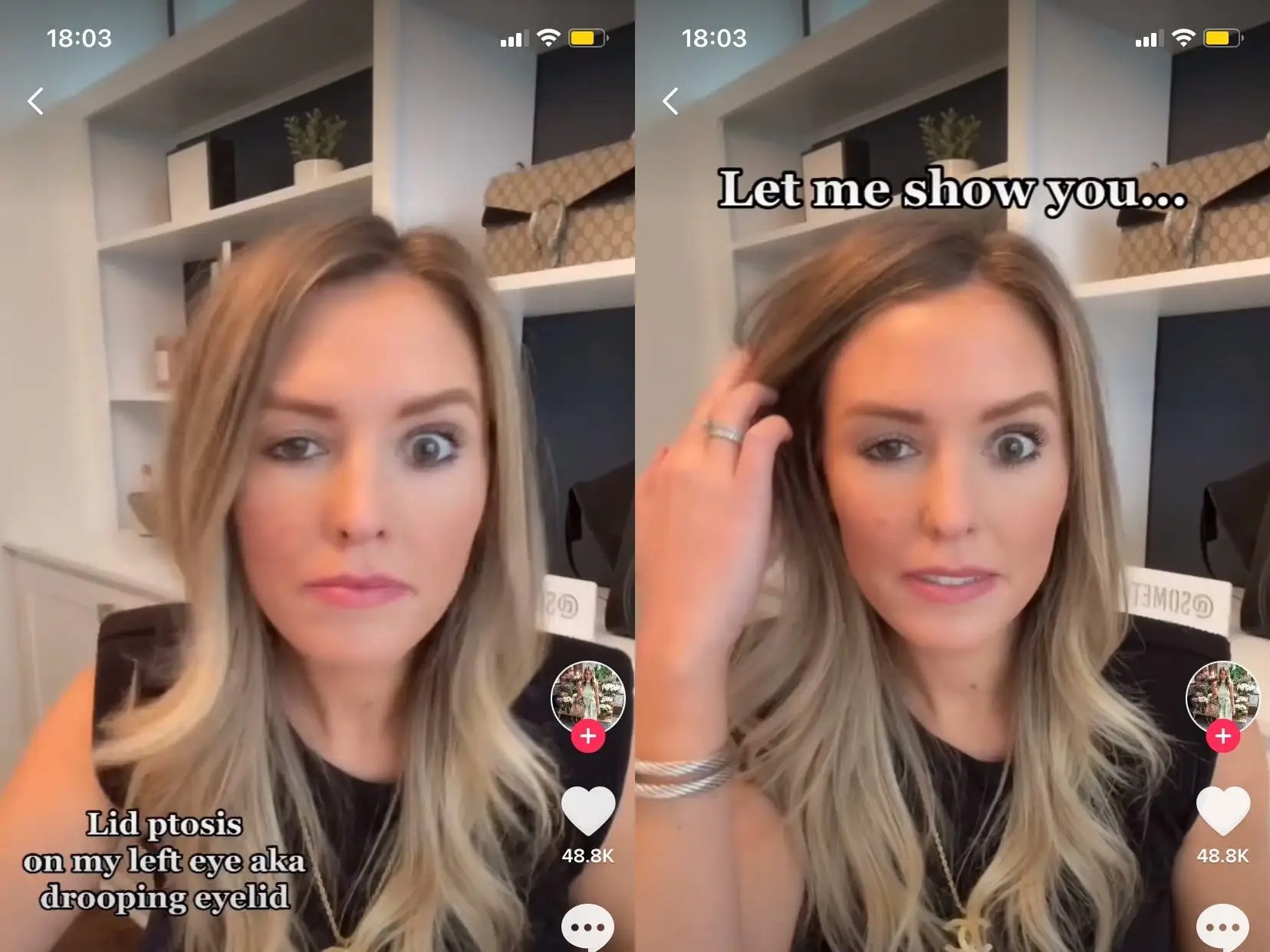 An influencer's botched Botox procedure left her with one