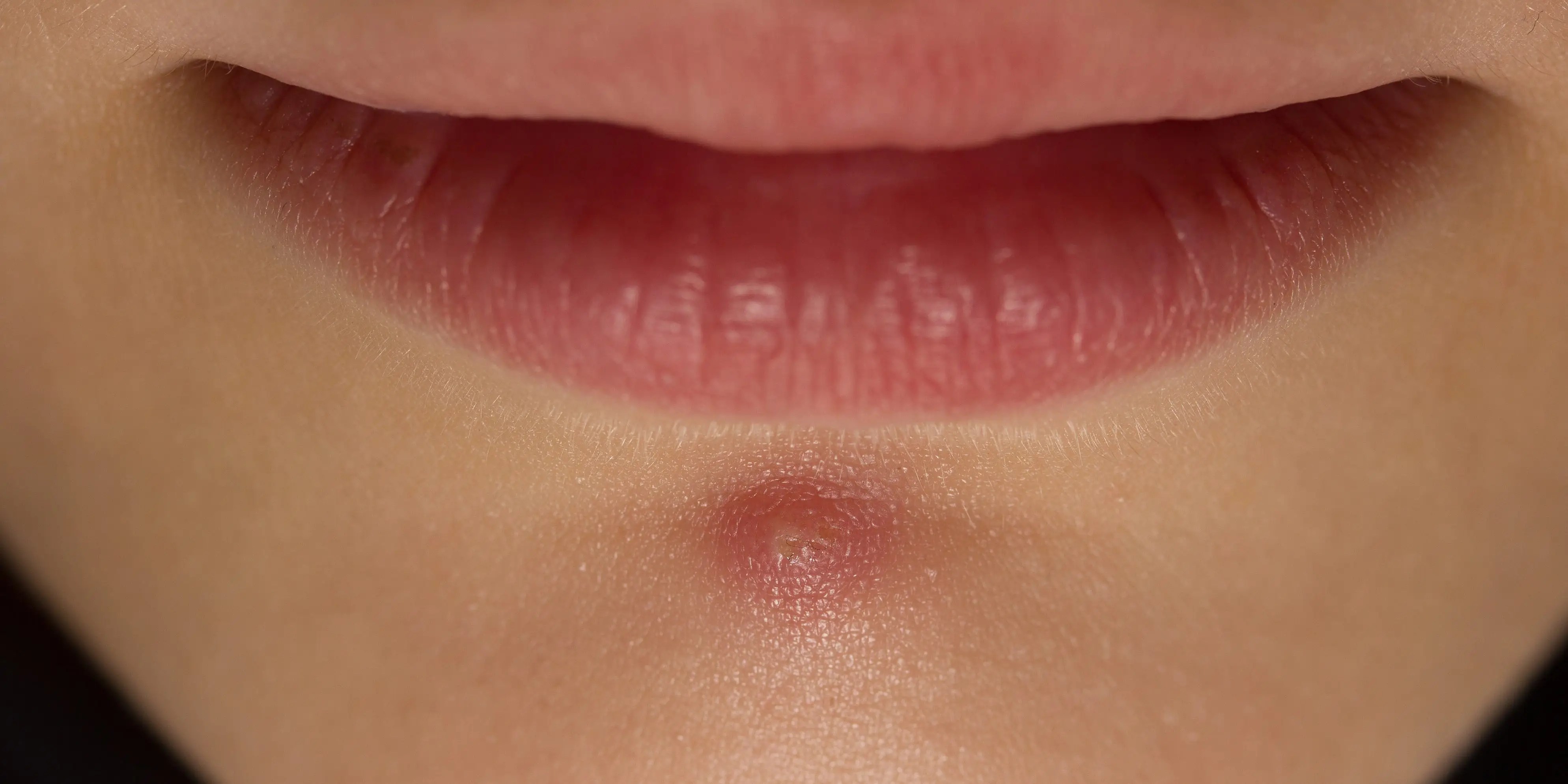 Blind Pimple How to Treat Under the Skin Acne