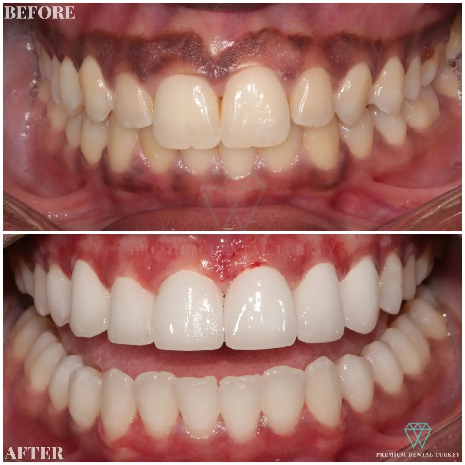 Are Veneers Cheaper In Turkey WHCUM