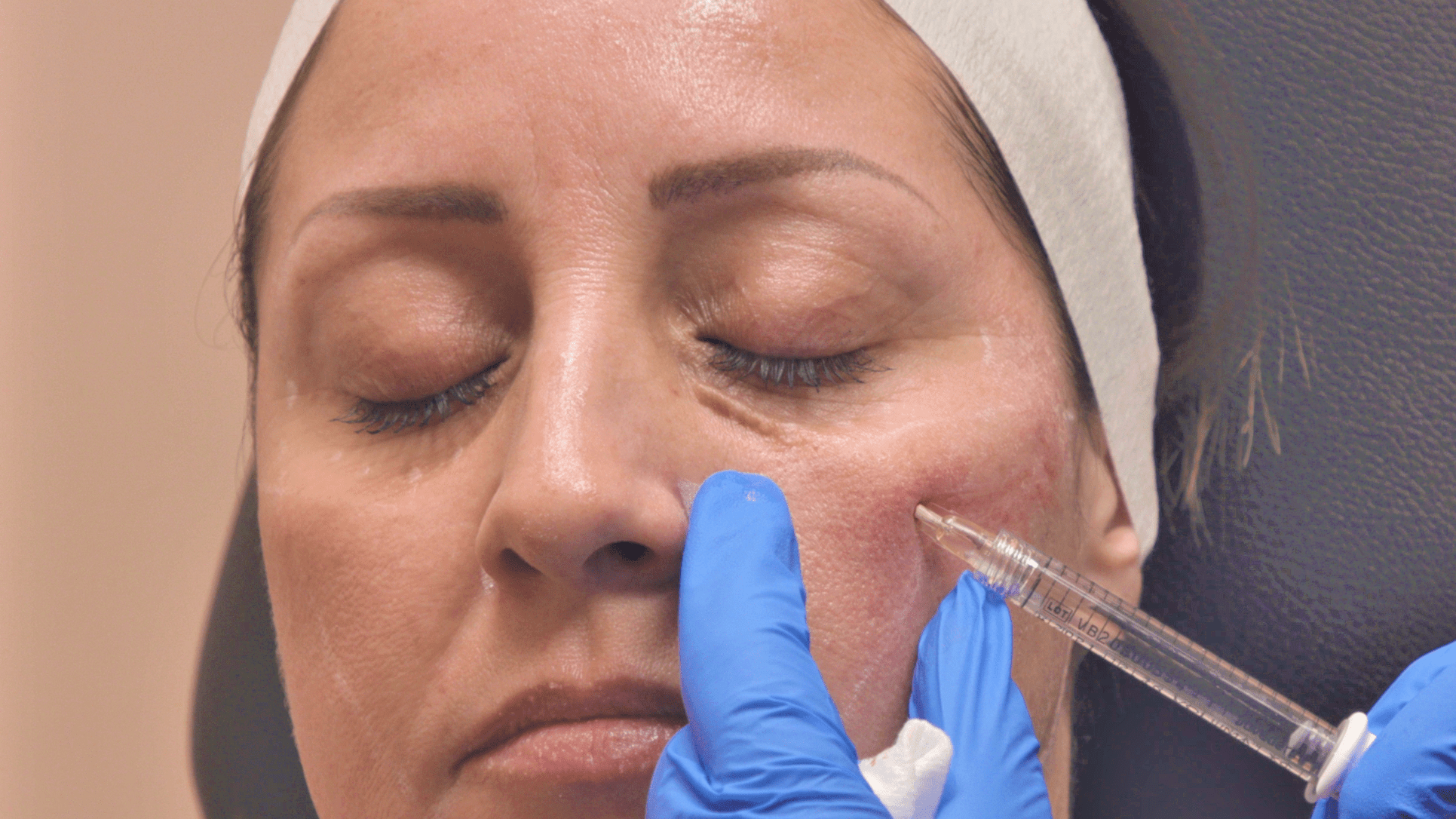 Video Shows What Lip and Face Filler Actually Looks Like