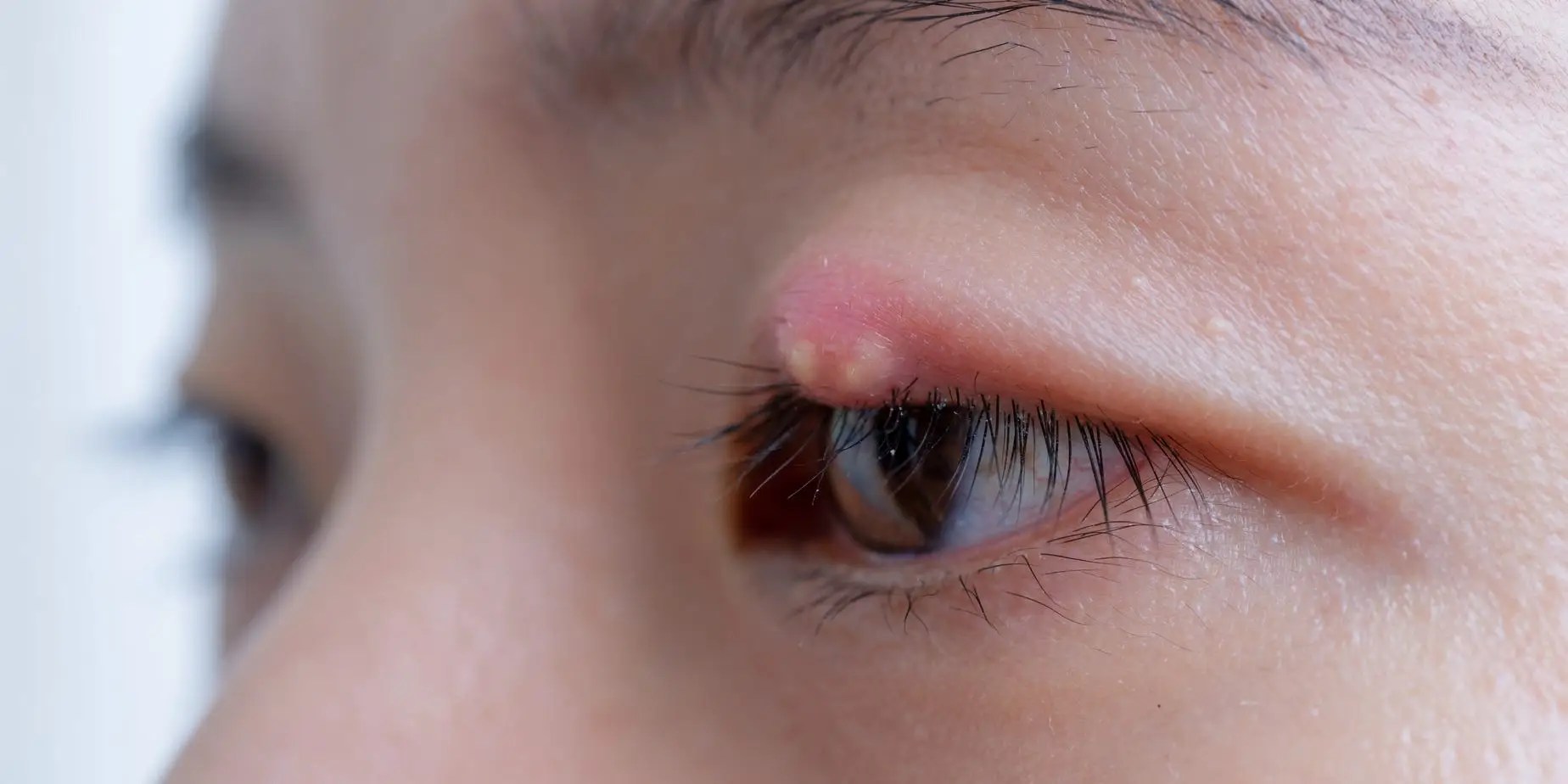 Eyelid Bump: How To Get Rid Of Styes And Other Bumps