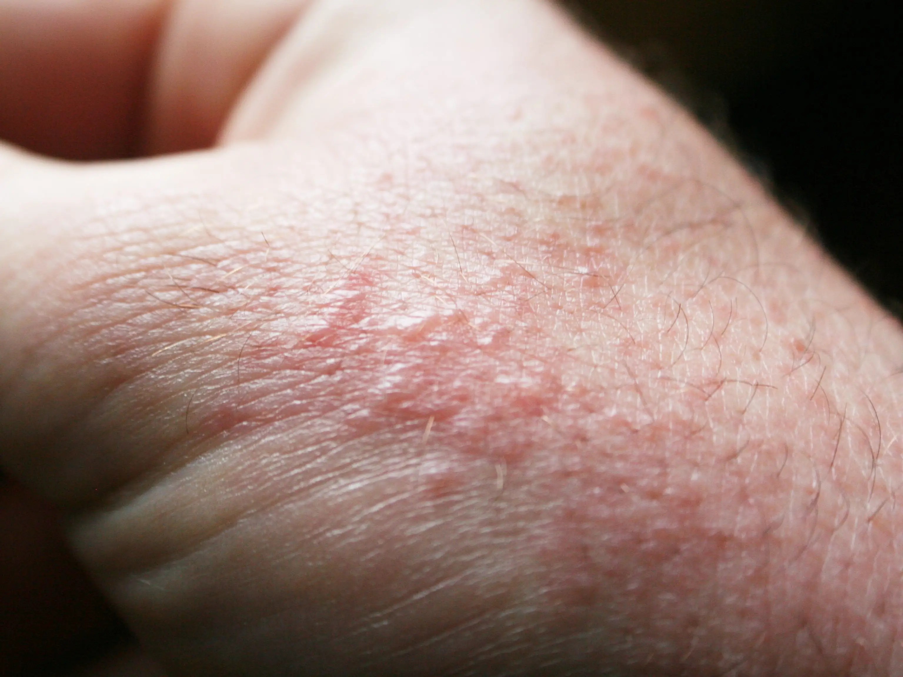What Does Poison Oak Look Like? How to Spot the Plant and a Rash