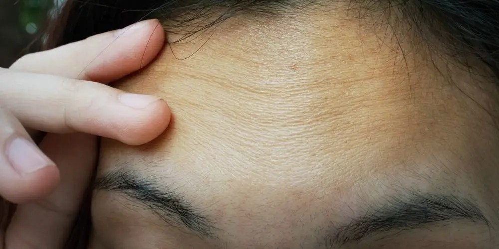 Forehead Wrinkles: 7 Ways To Get Rid Of And Prevent Them