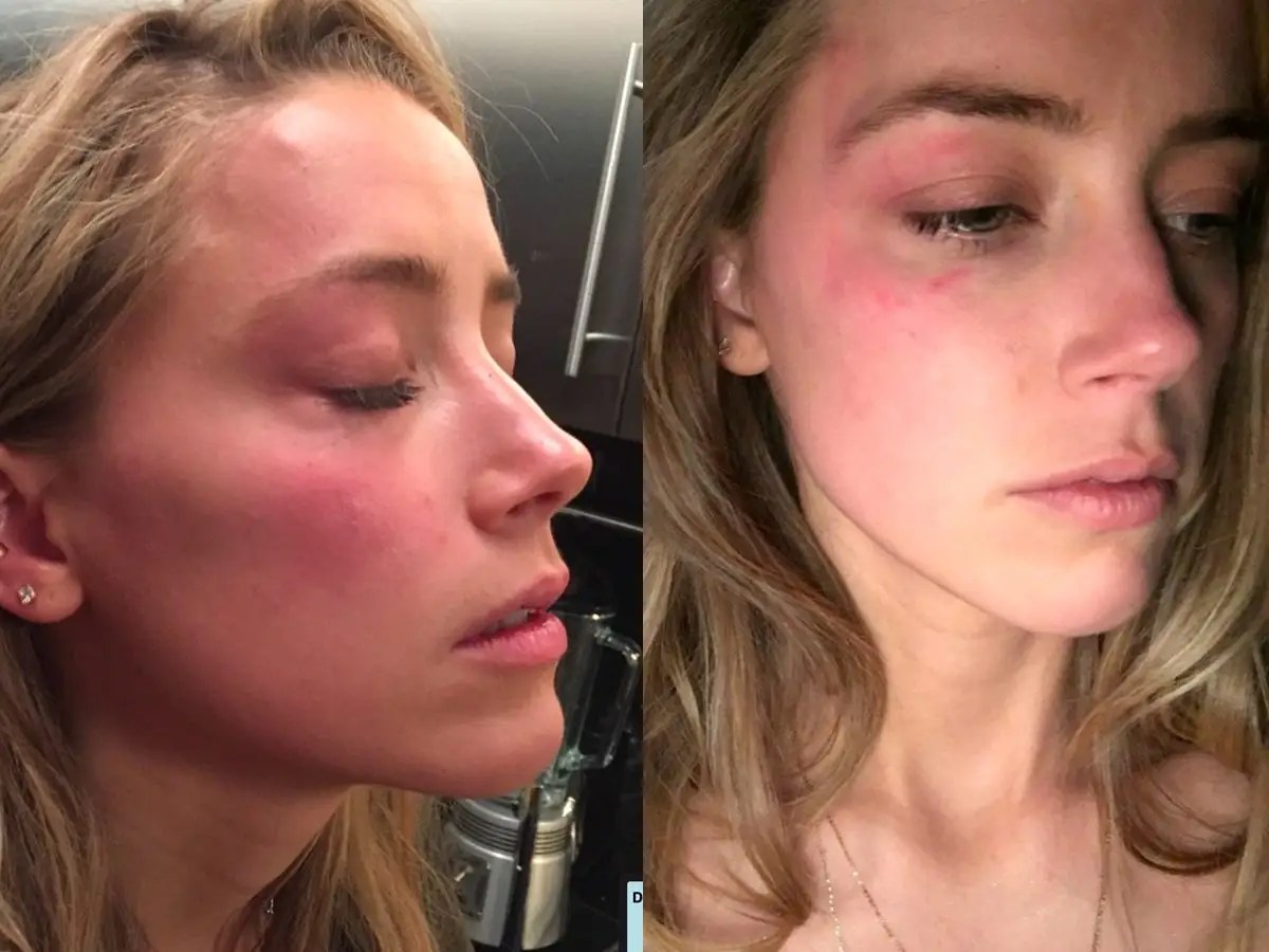 Amber Heard Seen With Red Bruises After Johnny Depp Allegedly Abused