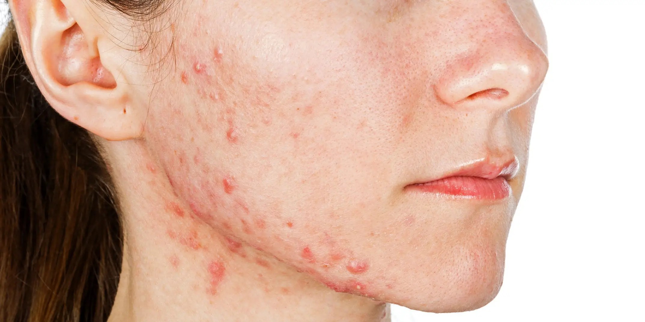 How to treat hormonal acne caused by PCOS, according to a women’s health expert and a derm