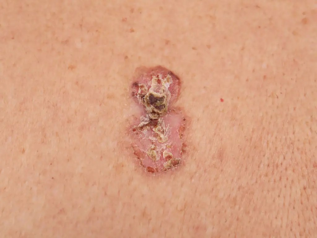 Symptoms Of Skin Cancer On Leg