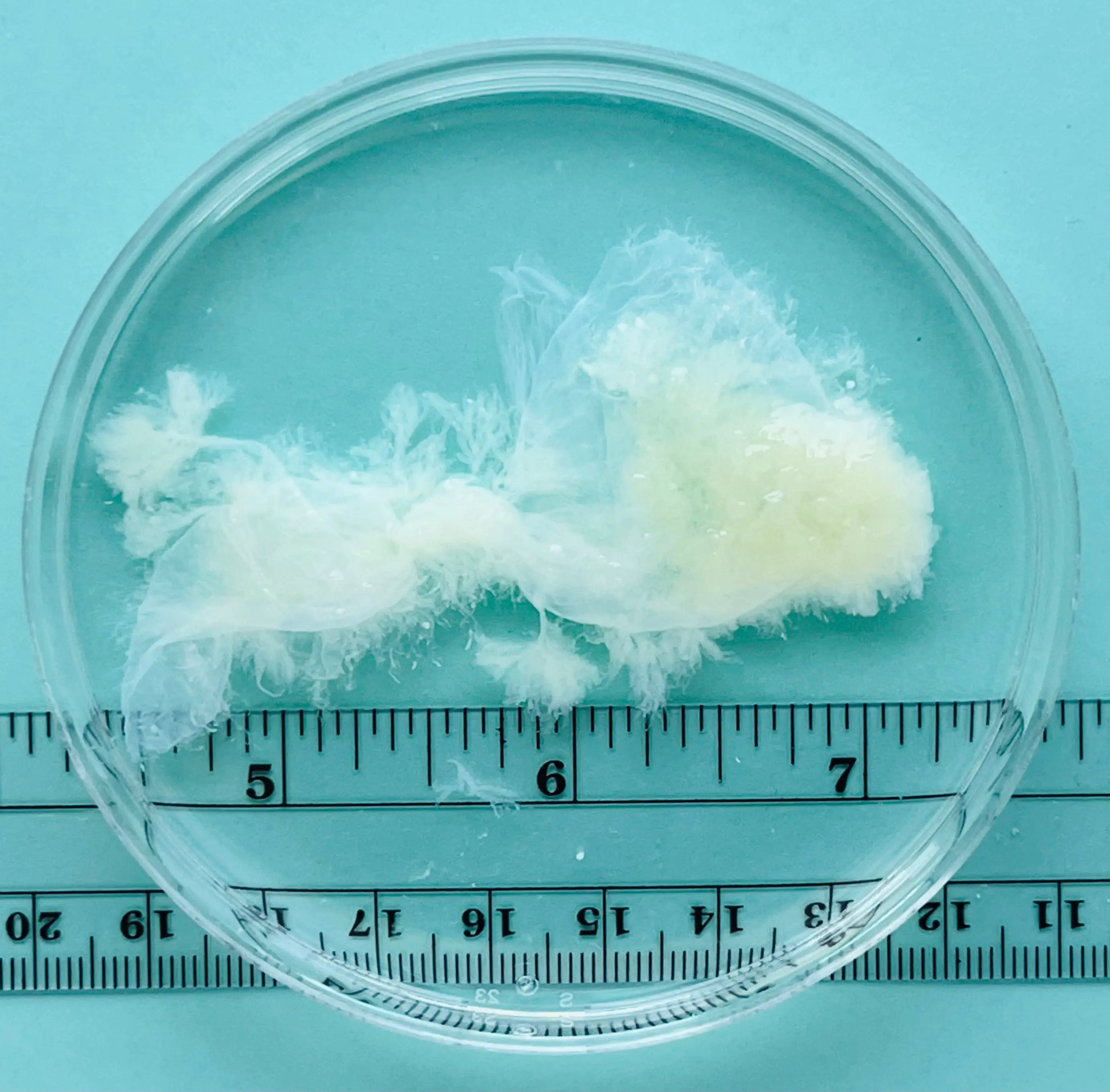 6 Week Miscarriage Looks Like The Uncensored Reality Of What A