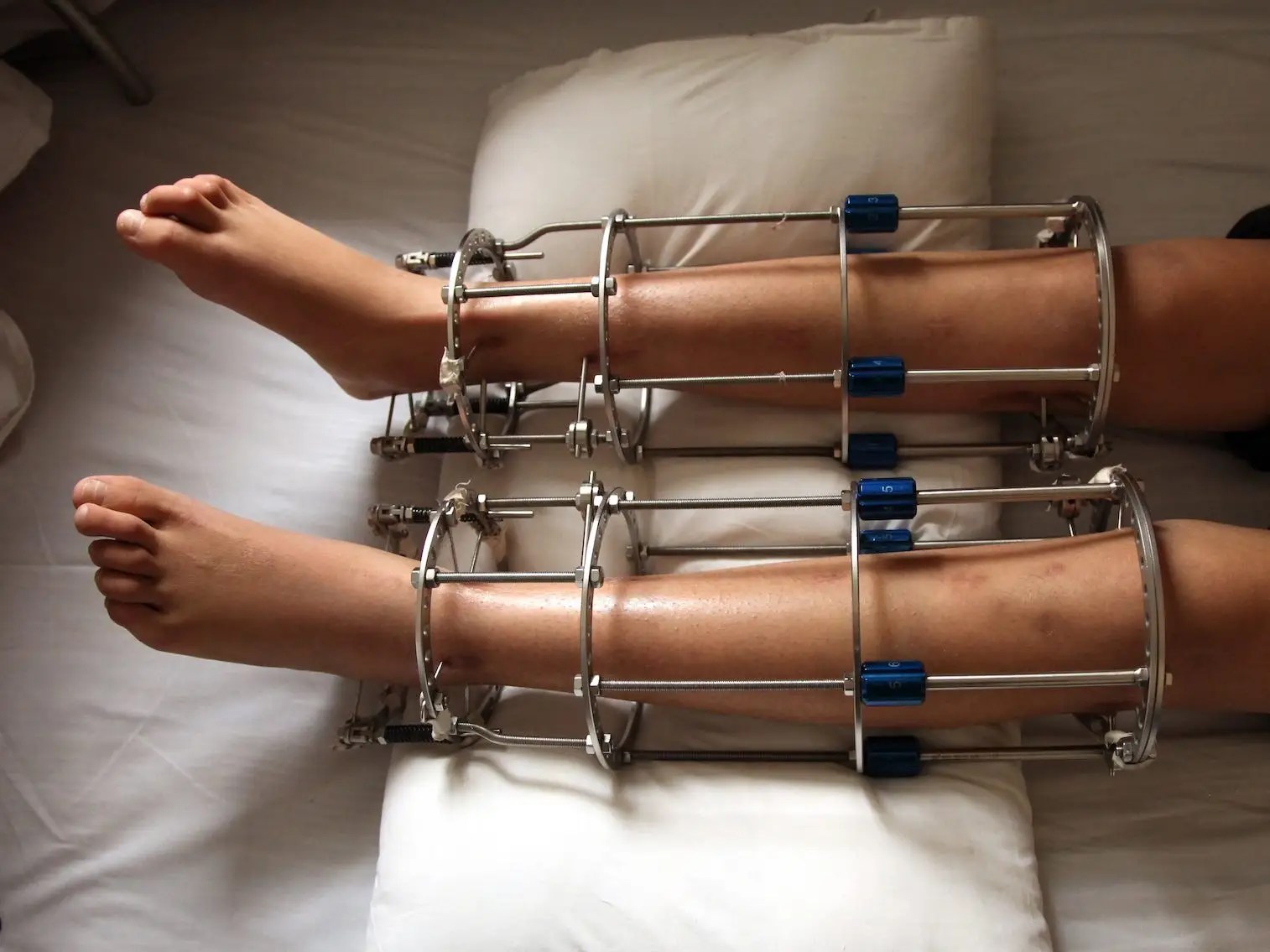 LegLengthening Surgery Risks Surgeons Say Should Be Last Resort