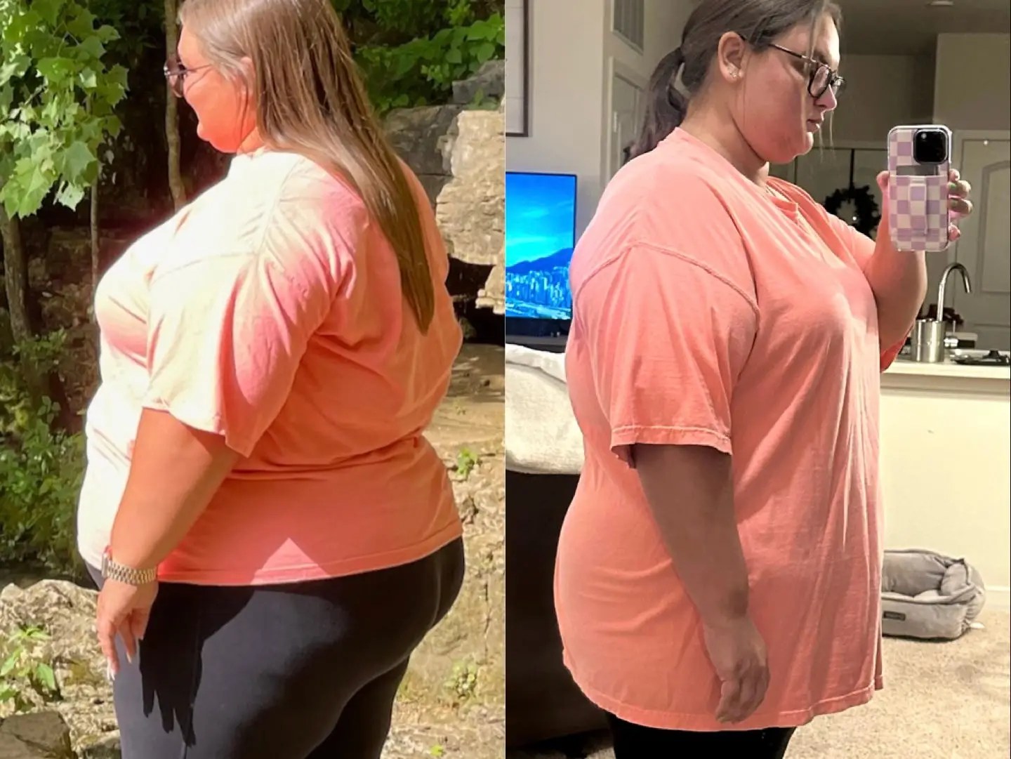 Woman Loses 82lbs on Semaglutide As Alternative to Bariatric Surgery