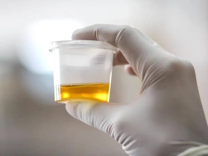 Increased protein in urine analysis causes and possible pathologies