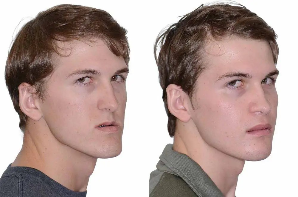 Osteotomy of the upper jaw before and after photos, reviews Health 2024