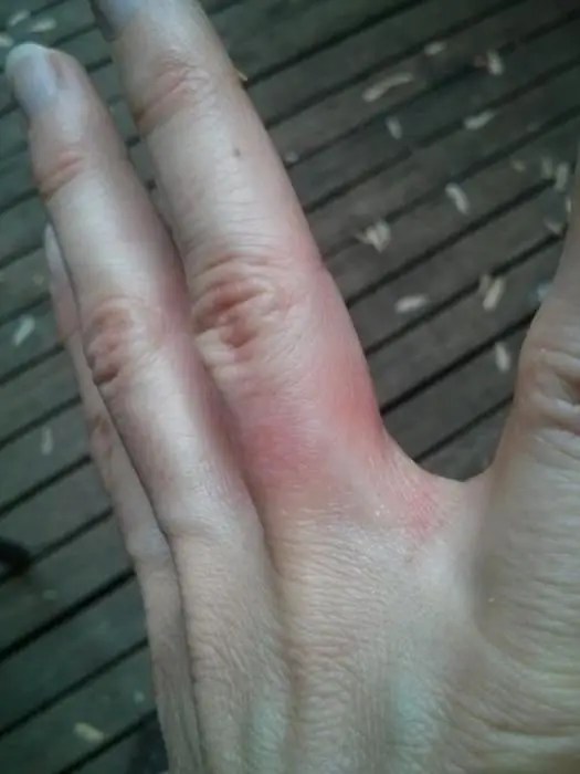 Silver allergy possible causes, symptoms and treatment features