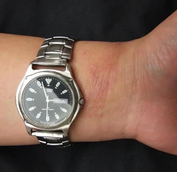 Silver allergy possible causes, symptoms and treatment features