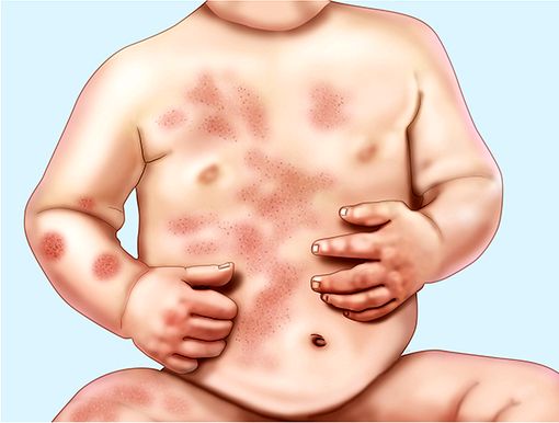 💉 Nummuläres Ekzem Ursachen, Symptome und Diagnose Dein