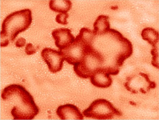 💉 Nummuläres Ekzem Ursachen, Symptome und Diagnose Dein