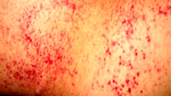 💉 Petechien Ursachen, Behandlungen, Bilder und mehr Dein Arzt 2020