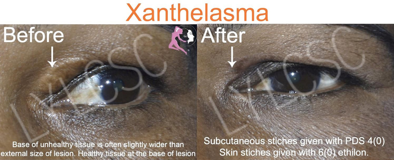 Xanthelasma Treatment Look Young Laser & Cosmetic Surgery Center
