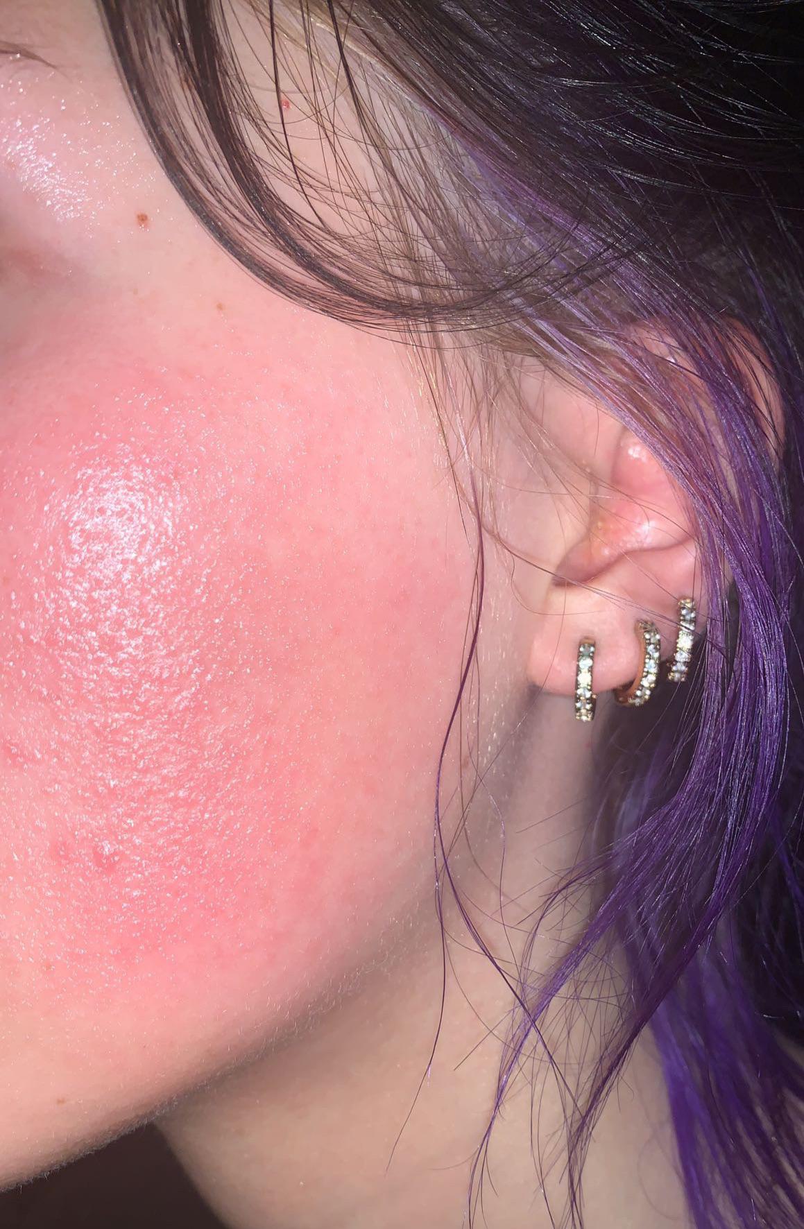 Allergic reaction? I’ve been using The Ordinary retinol serum at night before derma e vitamin C