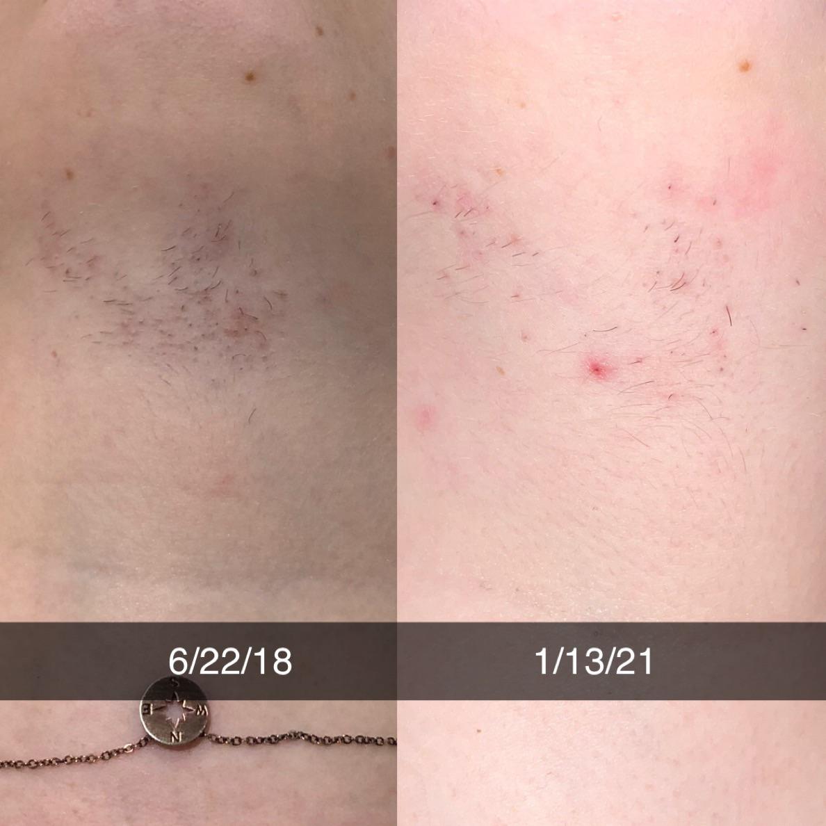 2.5 years ago I did 8 treatments of laser hair removal on my neck. I’m