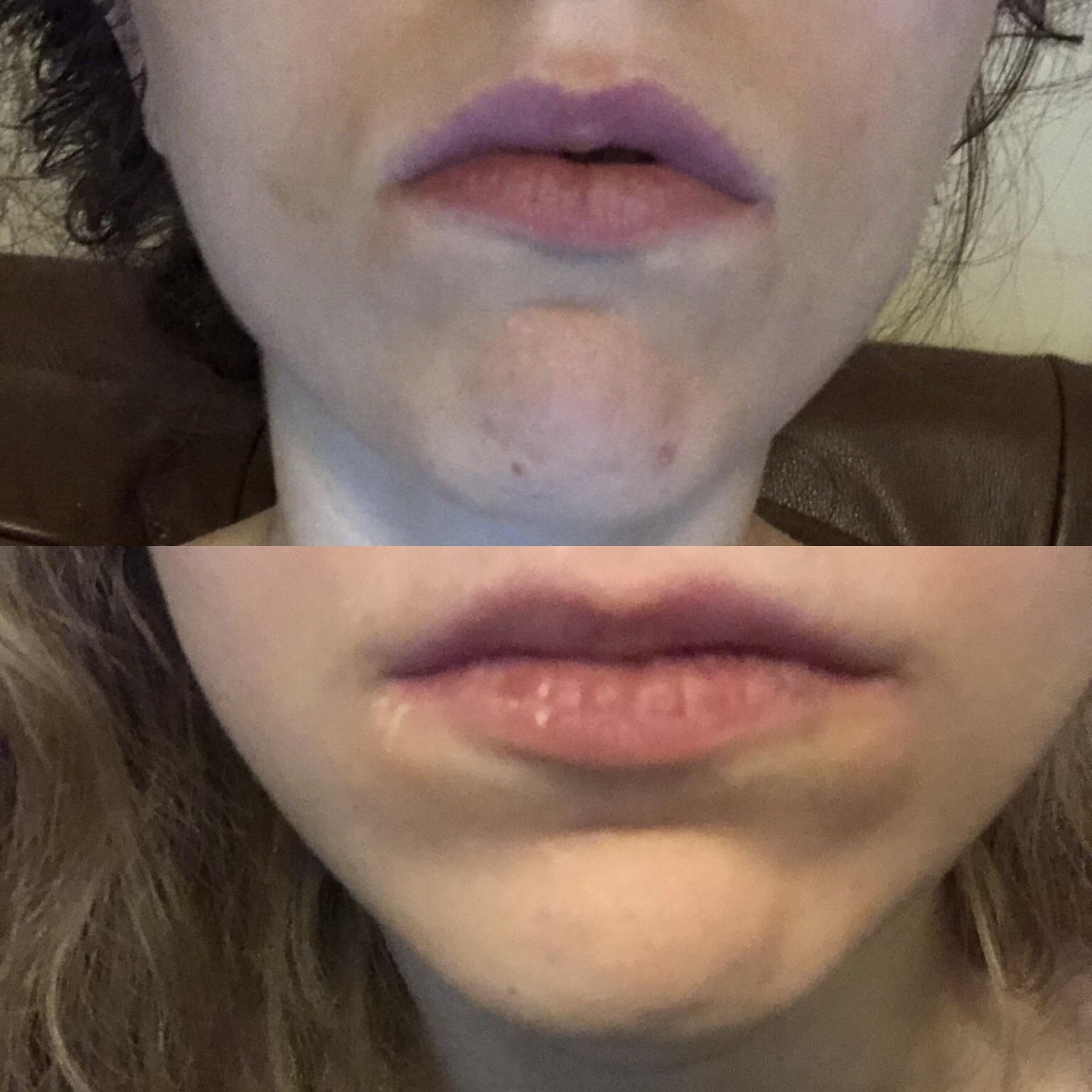 Correcting open bite seems to be fixing face shape and lip Now onto trying to