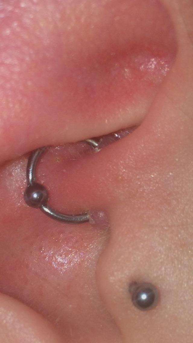 Help with bumps on my Daith? piercing