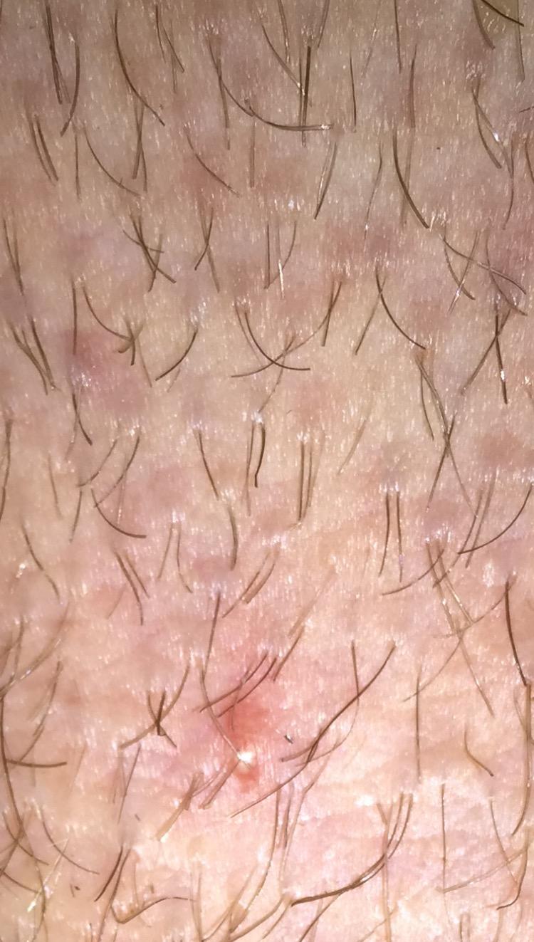 Herpes or Folliculitis? STD