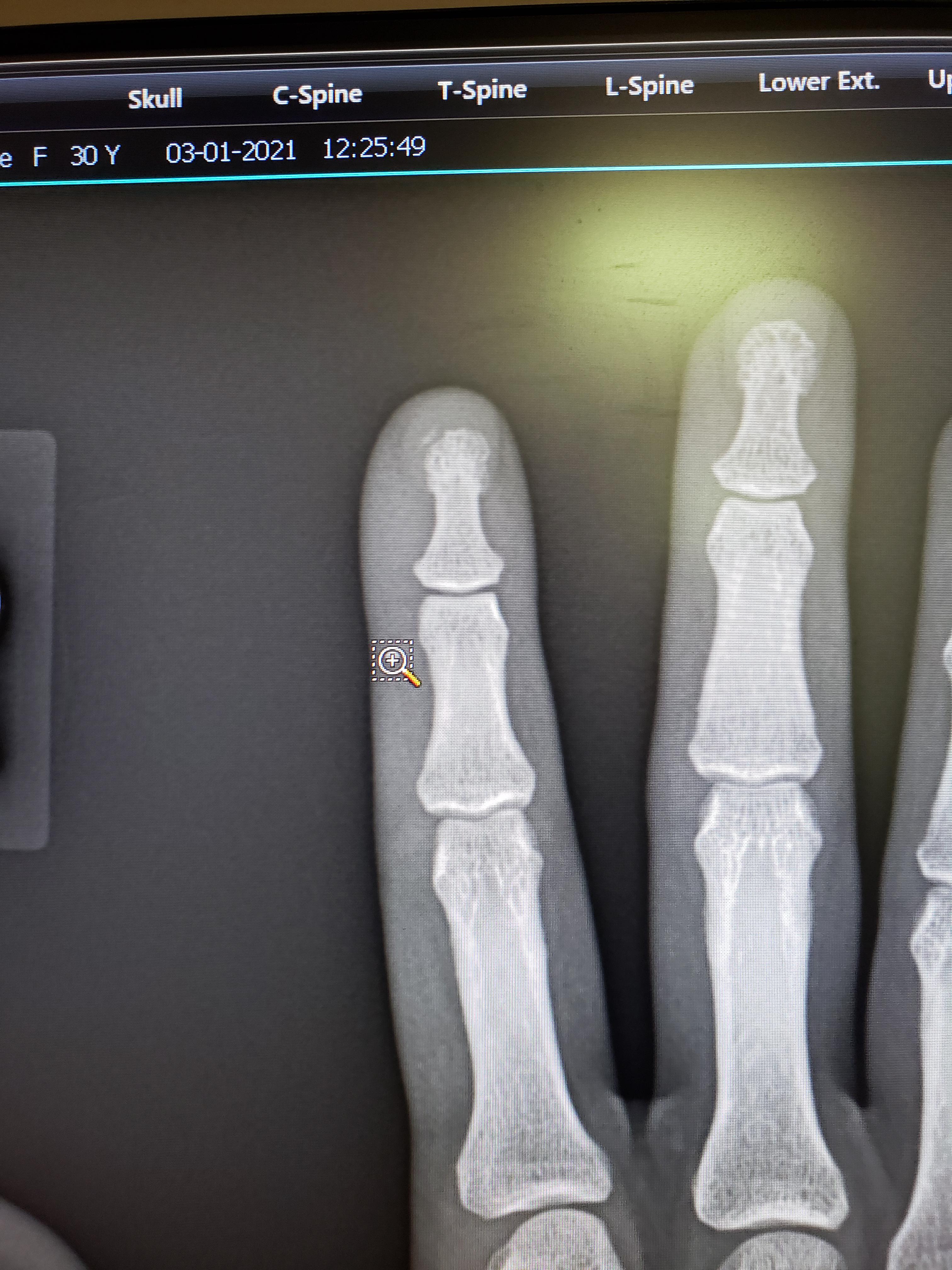 Have a baby fracture on my fingertip from slamming the car door on it