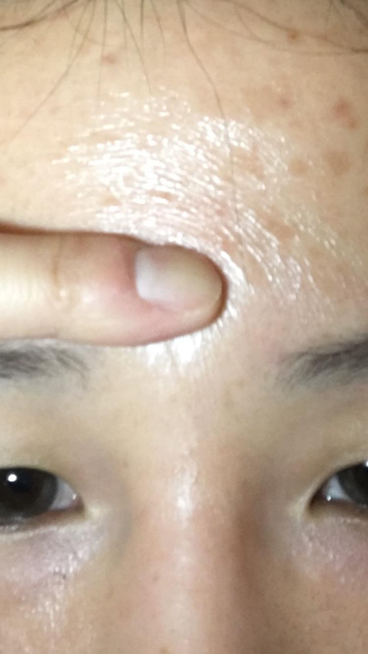 [Skin Concerns] Is this skin supposed to peel off? Dry, hard, crepey