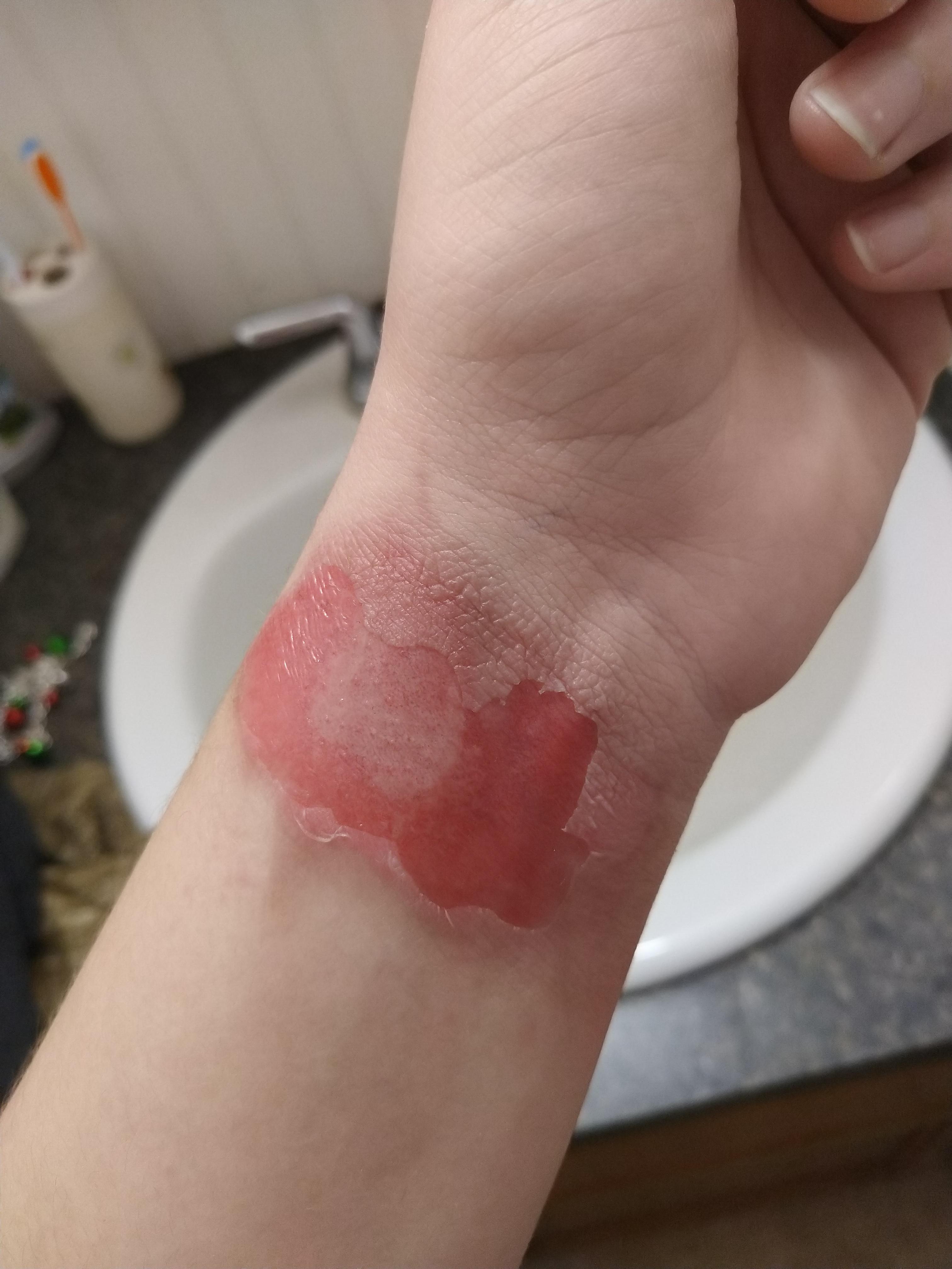 Airbag Burn, Day 4 r/injuries
