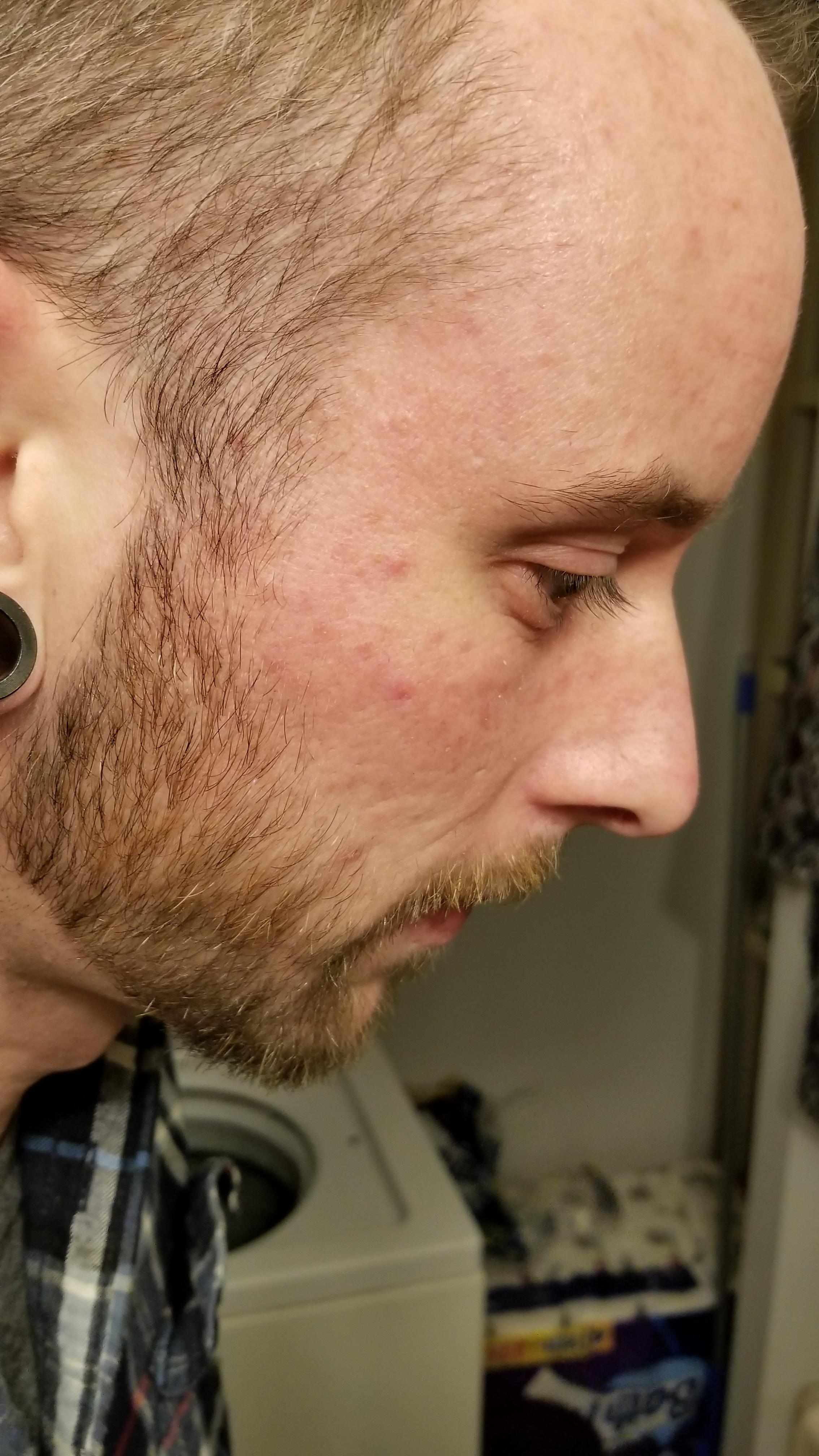Gluten Rash On Face