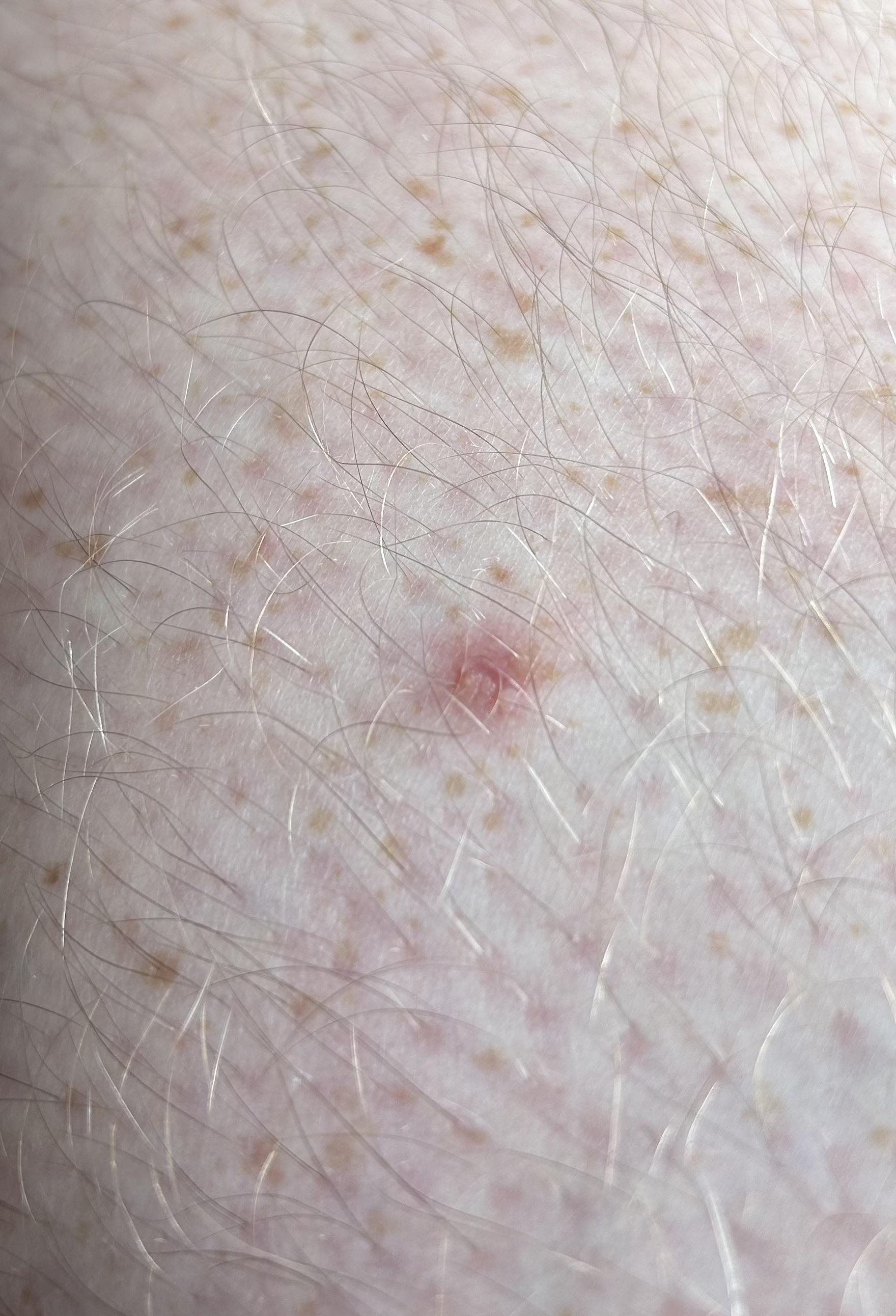 Red mark on skin with small hard lump underneath. r/medical_advice