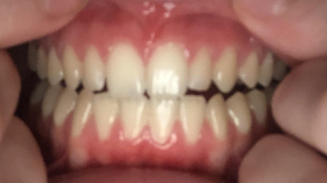 How To Cure Gum Disease Reddit Home and Garden Reference