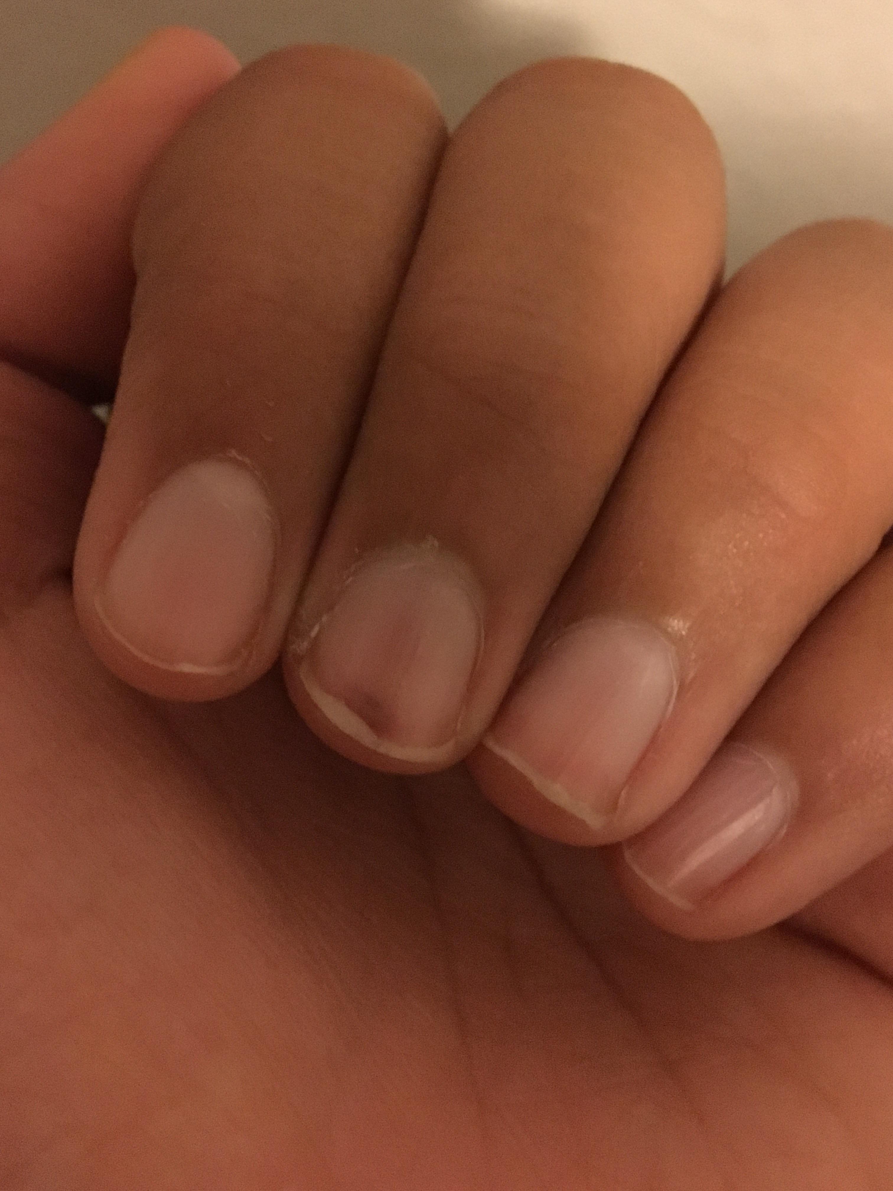 This Bruise Under My Fingernail r/mildlyinfuriating