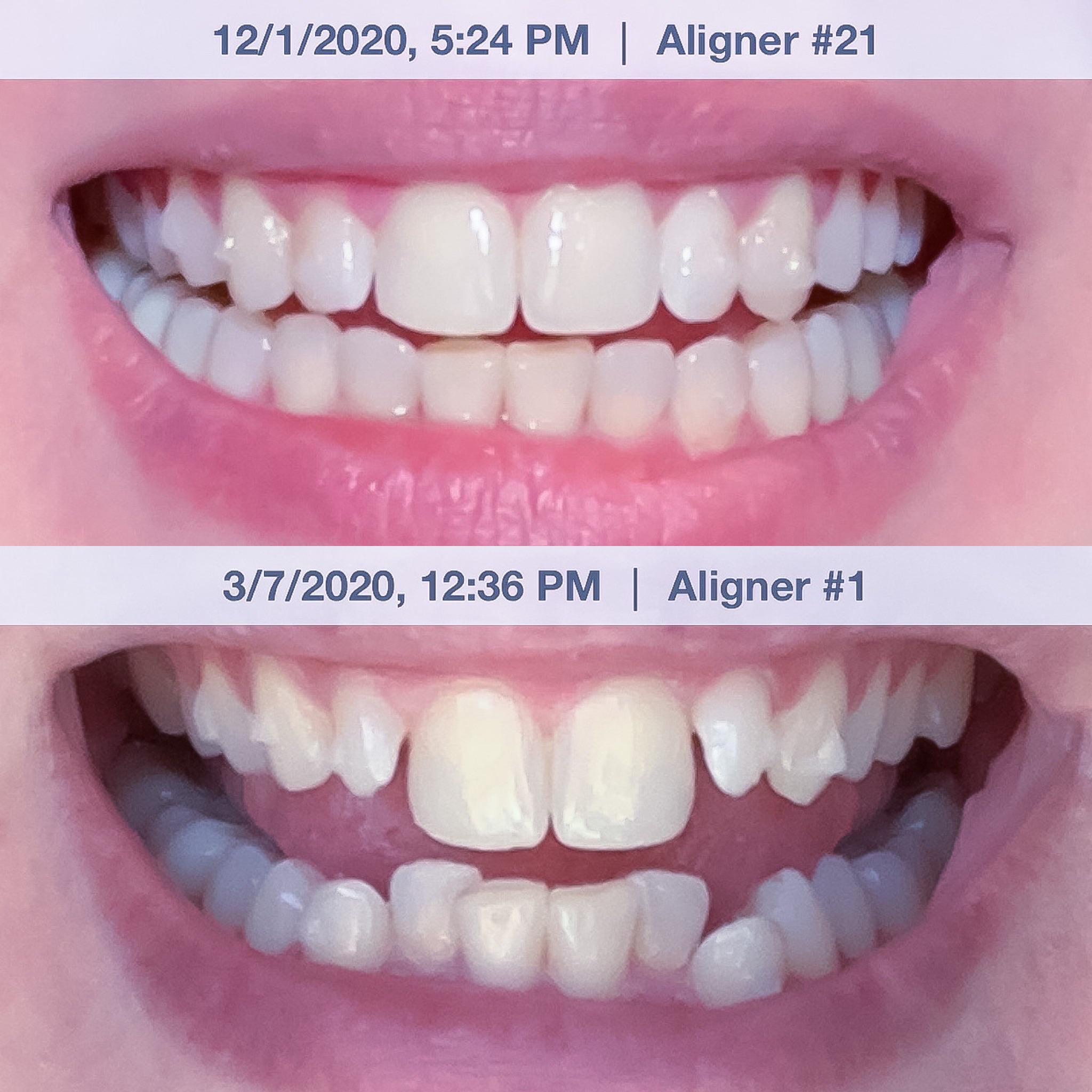 How long does it take to get used to this? : Invisalign